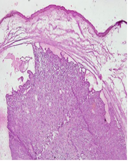 Microscopic features of the base tumor mass in the frozen section