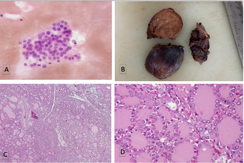 The histopathological examination of the thyroid specimen 