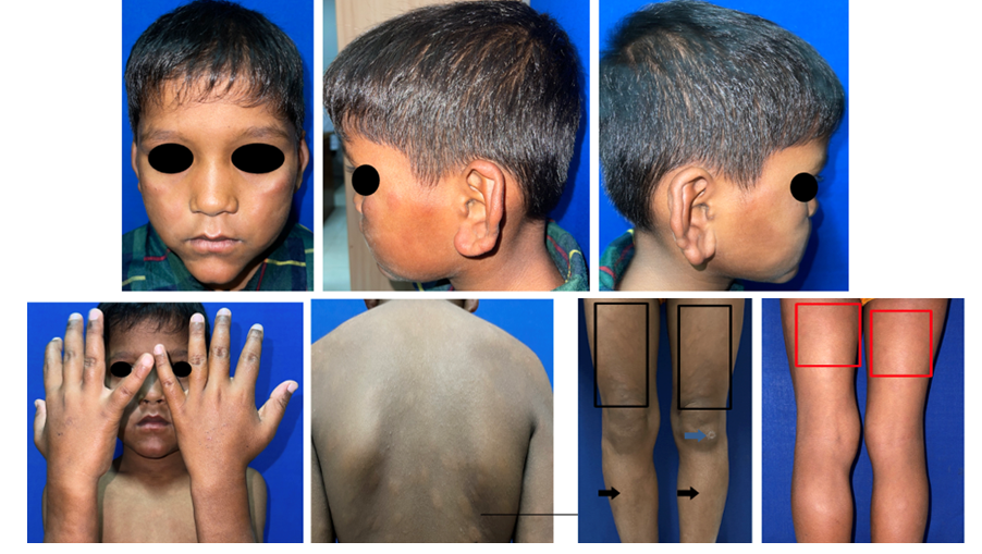 Erythematous plaques, infiltrates on both of cheeks, ears lobe erythematous on left arms, on chest, on both thigh, xerosis and blackish crust both hands and oedem on the feet
